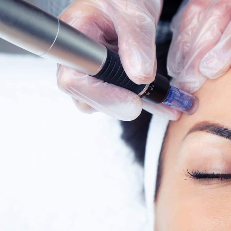Morpheus8 treatment Wigan from Lipo Sculpt - Book in today!